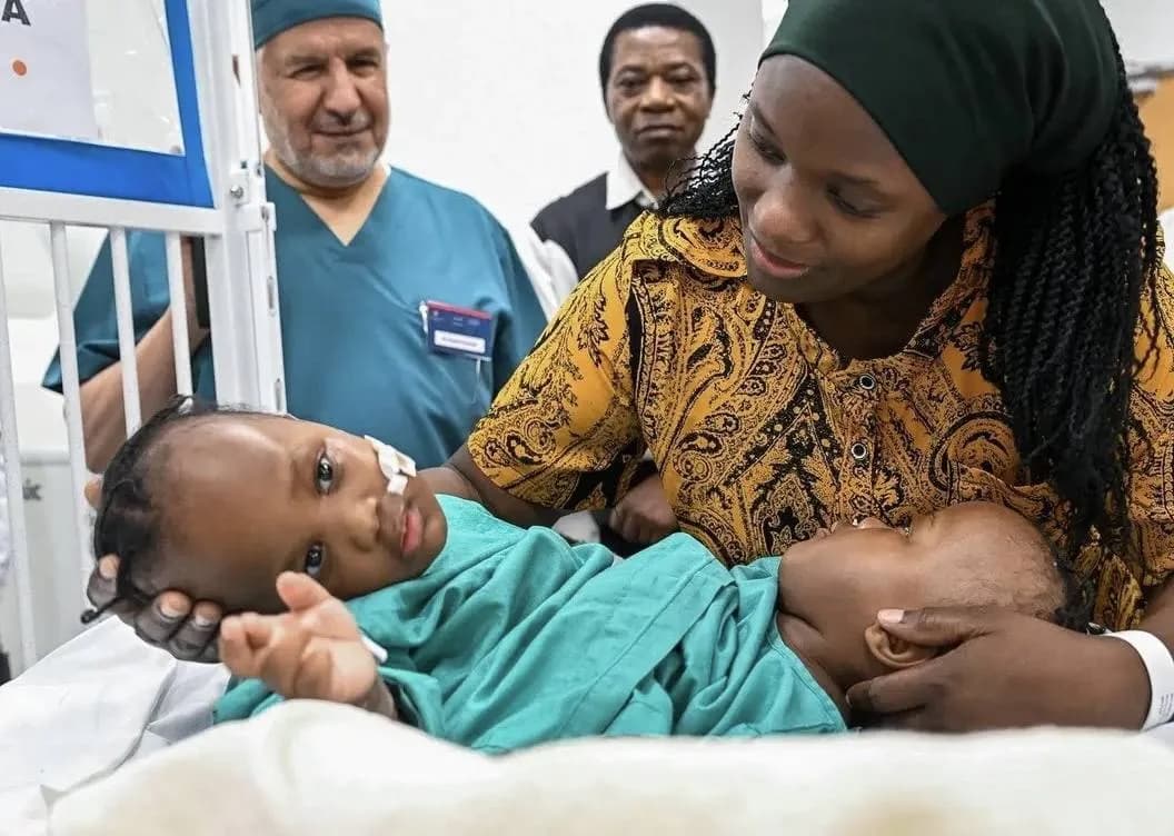 بدء عملية فصل التوأم الملتصق التنزاني نانسي ونايس في الرياض
