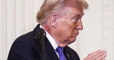احمرار وتقشير فى الجلد برقبة ترامب.. أطباء يكشفون سر الطفح الجلدى المؤلم