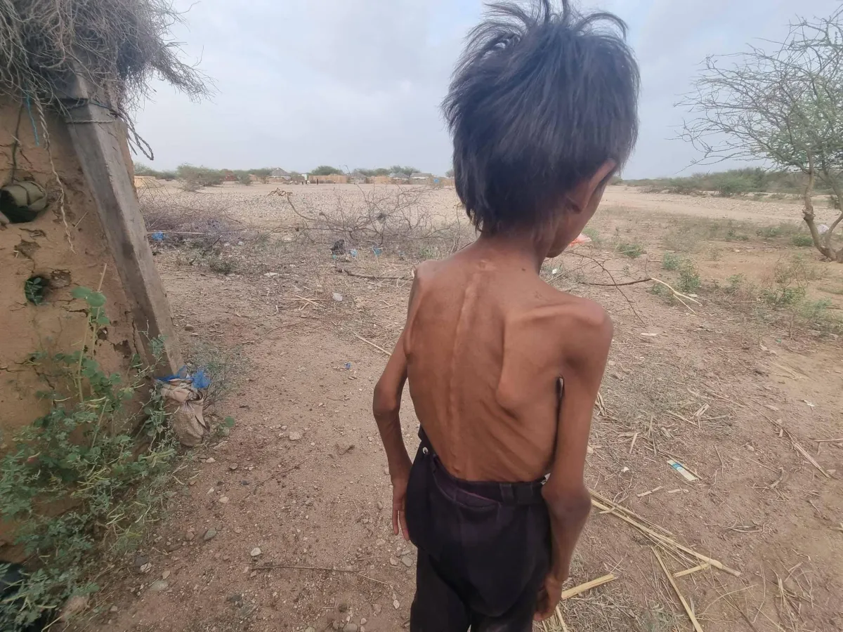 الجوع ينهش اليمن... والحوثيون يستخفون بالمأساة